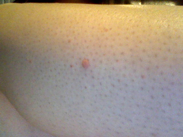 bump on leg bump on leg bump on leg bump on leg