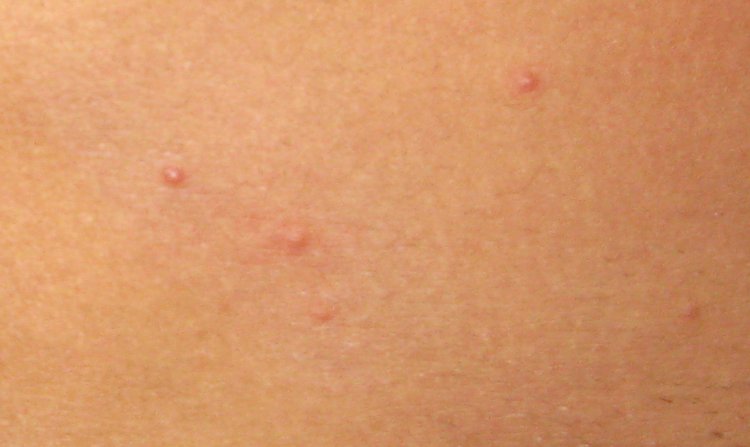 Bumps on Chest, Not Acne, Red, Itchy, White, Small, Under ...