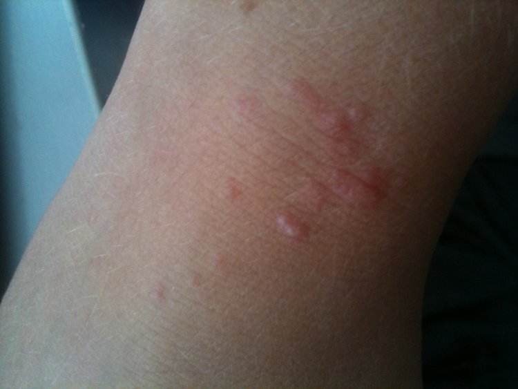 Itchy Red Patch On Wrist