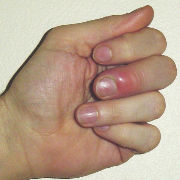 finger infections pictures