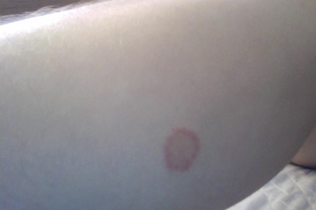 Dermatology: red itchy scaly round spot front of leg ...