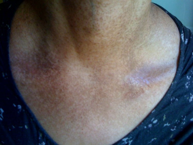 Dark+Skin+Patches+On+Neck Dark spots on my neck and spreading