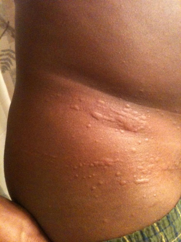 Common Rashes: Types, Symptoms, Treatments, & More - WebMD
