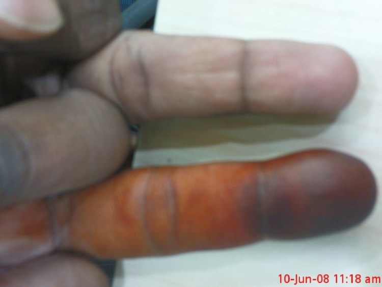 Swollen finger. Is this some fungal or bacterial infection