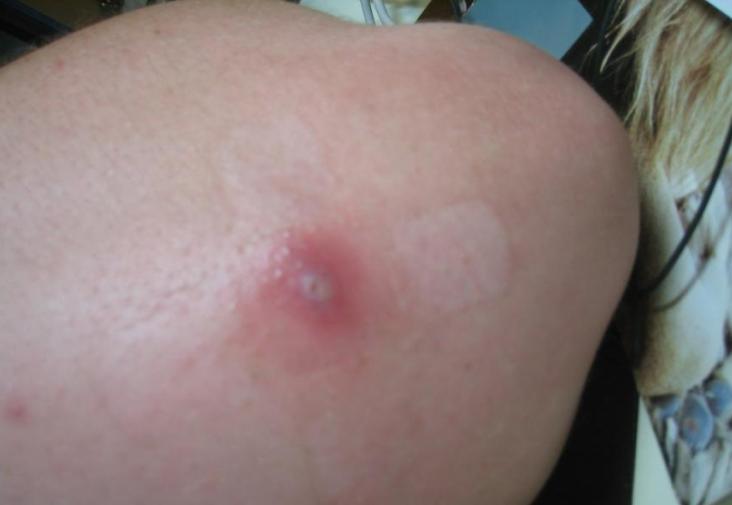 Name:  spider bite.jpg
Views: 522076
Size:  23.2 KB