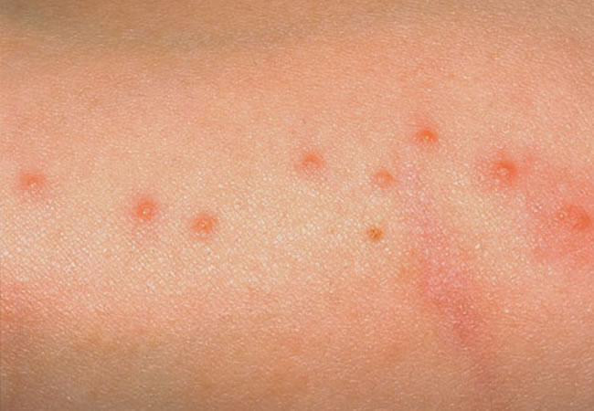 Name:  bedbug-bites-lg.jpg
Views: 135
Size:  49.3 KB