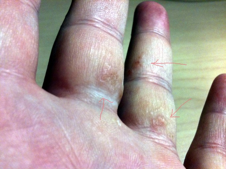 Tiny Itchy Bumps On Fingers - Doctor answers on HealthTap