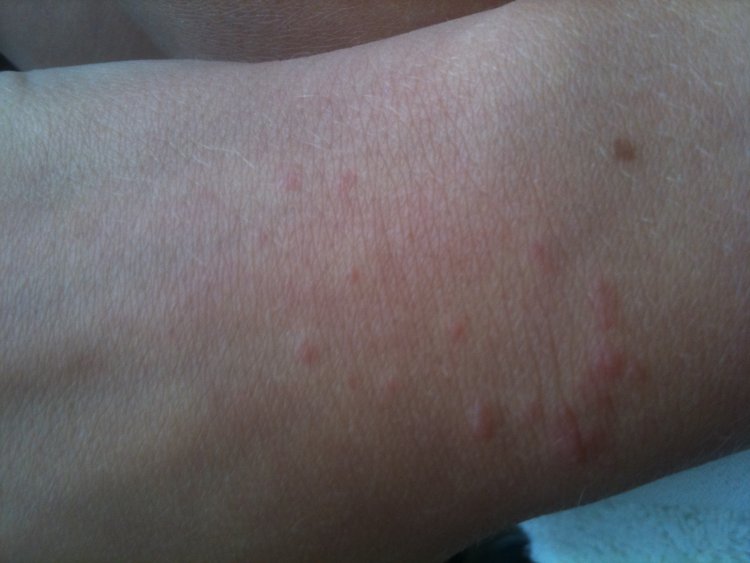 Itchy Bumps On Wrist