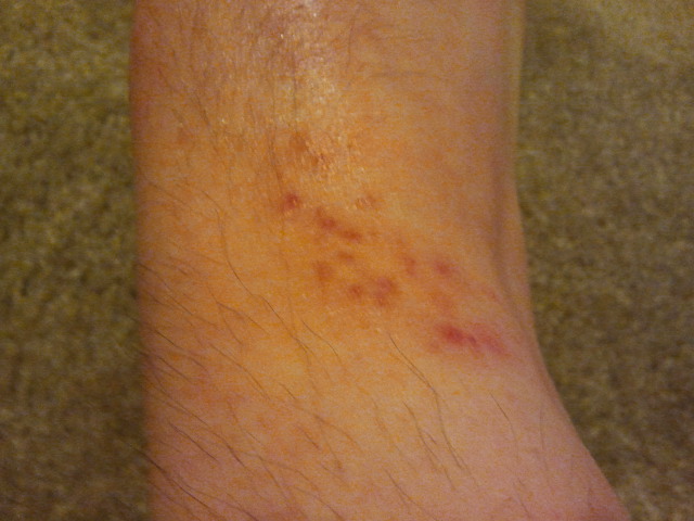 Tiny Red Spots Rash On Feet 65